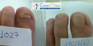 hongos en las uñas tratamiento