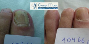 tratamiento hongos en las uñas