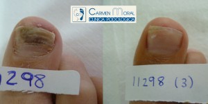 hongos en las uñas tratamiento