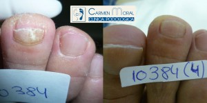 tratamiento onicomicosis