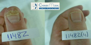 hongos en las uñas
