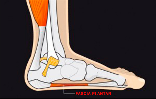 Qué es la fascitis plantar